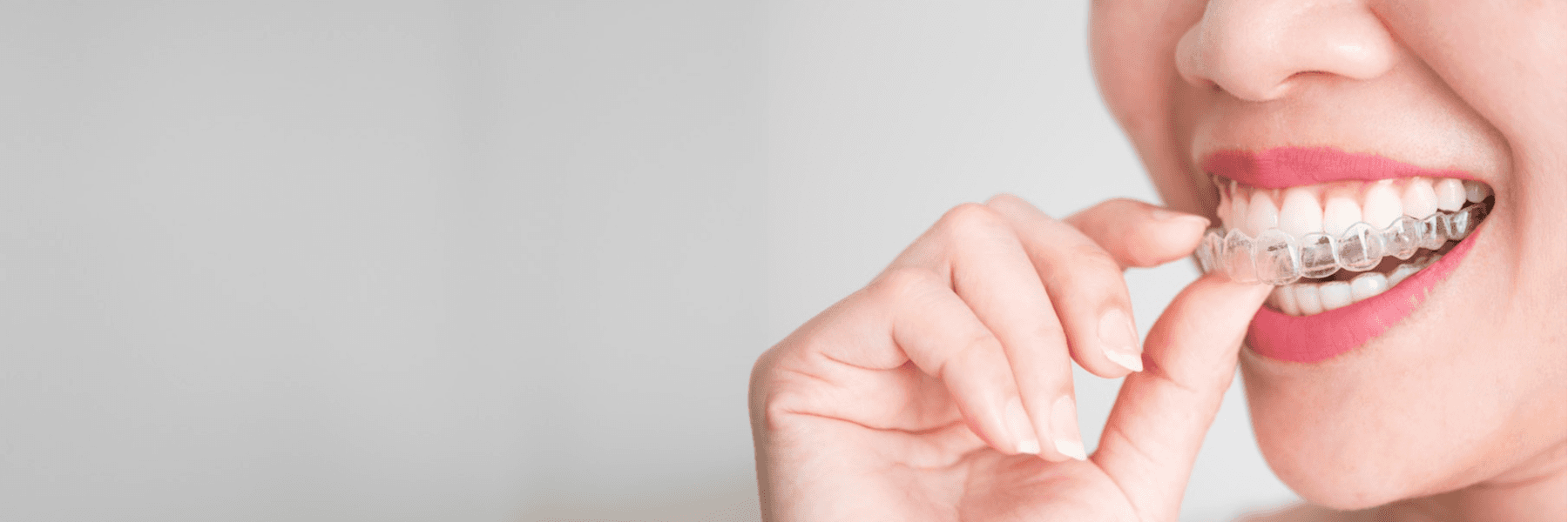 Clear Aligners | Dentist